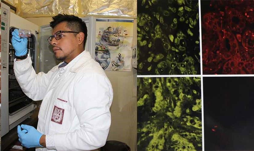 El cáncer de mama es un tipo de cáncer que se forma en las células de las mamas, en México 37 de cada 100 mujeres que egresan por cáncer