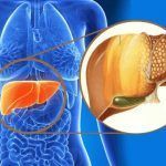 ¿Qué es el hígado graso y cómo prevenirlo?