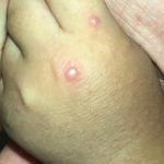 ¿Sabes cuál es la enfermedad pie, mano, boca? Alertan en Hidalgo